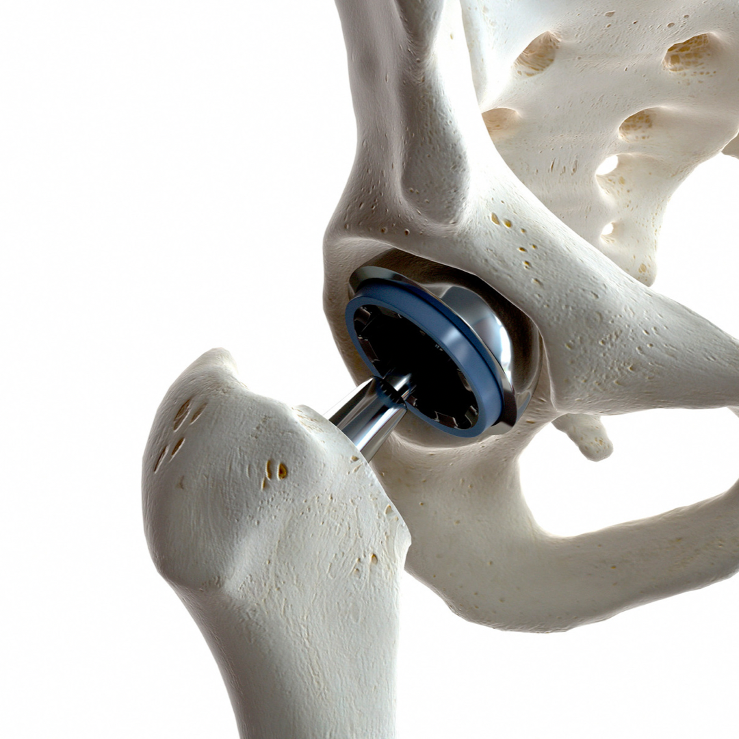Gardeners, Gratitude, and Hip Surgery